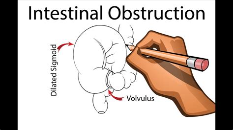 Intestinal obstruction can cut off the blood supply to intestinal obstruction. Intestinal Obstruction - Part 1 - YouTube