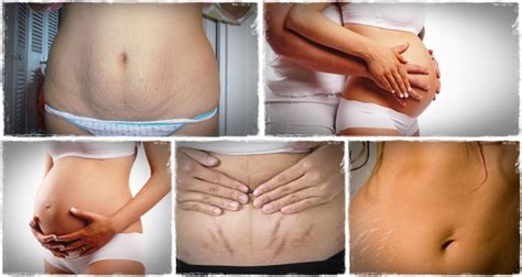 But is laser hair removal safe while pregnant? 8 Natural Remedies to Remove Pregnancy Stretch Marks - My ...