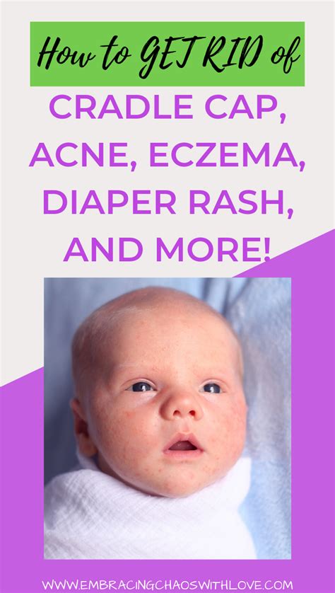 Natural Remedy for Common Newborn Rashes | Newborn rash ...