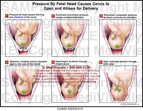 Once a woman's cervix is fully dilated, it's time to push. Medivisuals Pressure By Fetal Head Causes Cervix to Open ...
