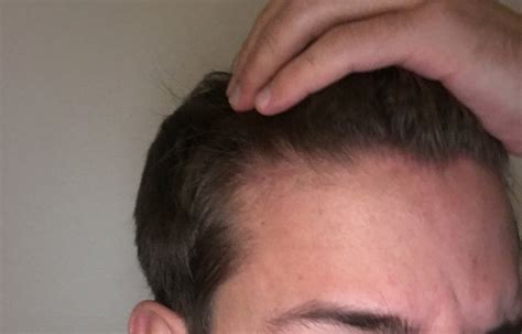 Best way to treat any disease is its prevention, as it is rightly said. Is This Early Stages Of Male Pattern Baldness ...