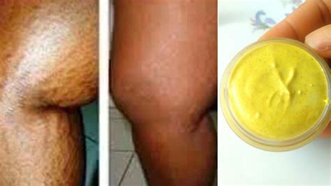 But it's not a total lost cause. DIY Stretch Mark removal Cream || Remove Stretch marks fast - YouTube