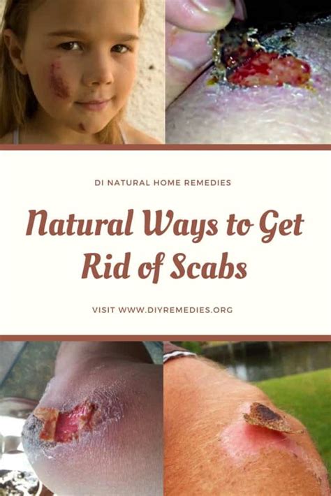 What are scabs and how to get rid of them? Natural Ways to Get Rid of Scabs