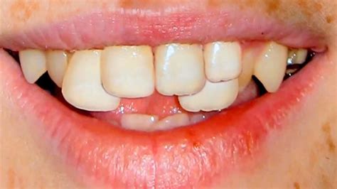 You can correct your crooked teeth without using metal brackets and wires or having fixed appliances on your teeth. How To Fix Crooked Teeth At Home - Grand How To Review