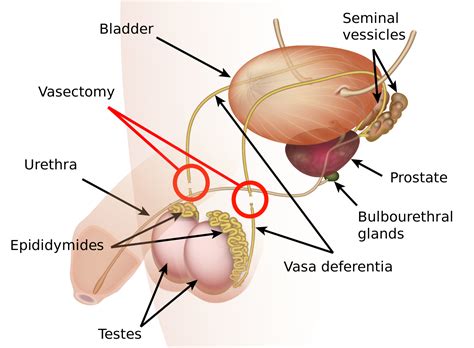 So you just had a vasectomy —now what? Vasectomy Before and After Tips and Changes You Should ...