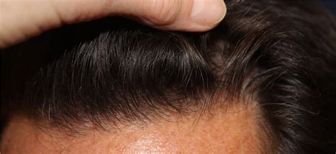 Hair regrowth, replacement, and restoration. Hair Transplant Before and After Photos by Richard Chaffoo ...