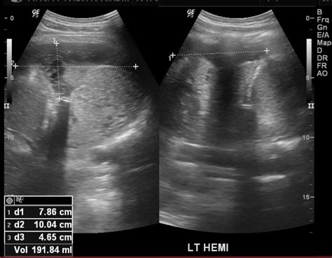 What is loculated fluid collection? Anterior mediastinal mass consistent with primary mediastinal large B cell lymphoma | Eurorad