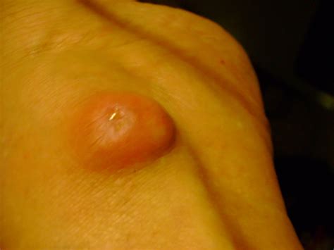 Symptoms like these need treatment right away. Secrets of Simple Living: Boil? Abscess? Cyst? Who Cares ...