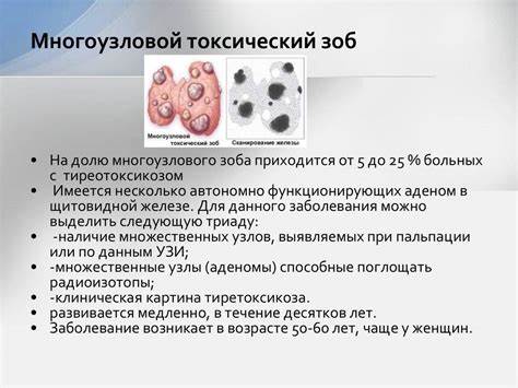 Зоб 2 степени диета Зоб щитовидной железы 2 степени: симптомы, диагностика и лечение Зоб щитовидной железы 2 степени: симптомы, диагностика и лечение Зоб 2 степени диета