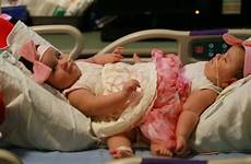 twins conjoined sisters birth separated cnn separation texas facts rare re fast their were surgery they