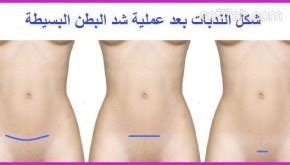تلمسة بشيء و يجب نعرفة المعلومات الصحيحه. شد البطن بعد الولادة القيصرية