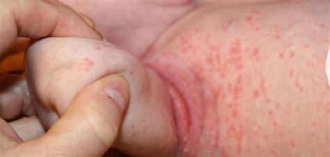 Es común que los niños con dermatitis atópica desarrollen con el tiempo. La dermatitis atópica alcanza ya al 15% de la población ...