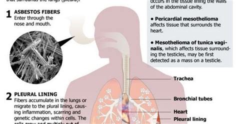 Learn how treatment can improve the prognosis of pleural mesothelioma Malignant Mesothelioma | Malignant Mesothelioma treatment ...