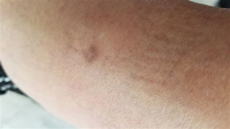 猛烈にかゆい湿疹ができたときに一瞬でかゆみを止める方法 ...