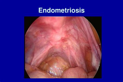 Learn about treatment, causes, stages, surgery, and diagnosis. PPT - Endometriosis PowerPoint Presentation, free download ...