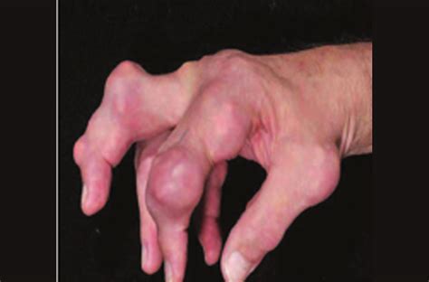 It typically affects the joints and often begins at the big toe. Tophaceous Gout