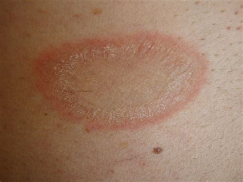 Consult a doctor for medical advice. Pityriasis Rosea Pictures, Stages, Causes, Treatment, Causes