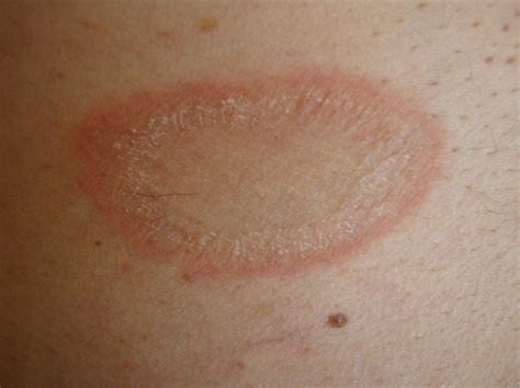 Some evidence indicates the rash may be triggered by a viral infection, particularly by certain strains of the herpes virus. Pityriasis Rosea Pictures, Stages, Causes, Treatment, Causes