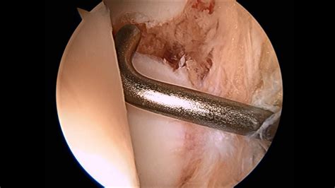 Narrated, annotated lecture 3 of 4 on malleolar ankle fractures (posterior malleolus and syndesmotic injuries) from the ota resident lecture series. Ankle Scope with Malleolus Fracture SFISM - YouTube