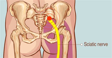 Sometimes this is caused by a contracture of muscles around the hip. What Muscles Attach Left Hip And Back : Iliopsoas ...