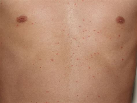 Aug 05, 2020 · pityriasis rosea is a rash that usually begins as a large circular or oval spot on your chest, abdomen or back. Pityriasis Rosea - Causes, Rash, Herald Patch, Stages ...