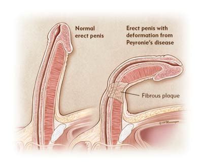 Discover the steps to do so and why it is so important. Medical Pictures Info - Peyronie's