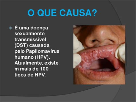 A palavra papiloma faz referências às típicas, porém nem sempre encontradas, verrugas que resultam da infeção por tipos específicos do vírus. Hpv