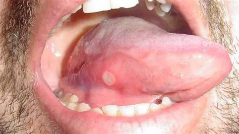 Small, Big, Sore Red Spots on Tongue Cause & Meaning - American Celiac