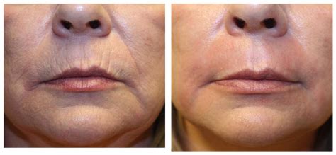 While an upper eyelid blepharoplasty is likely the best treatment for heavy upper eyelid skin, there may be a couple other options for you as well. Plasma Revival - Foxy Brow Microblading - San Diego