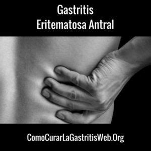 Below are 46 working coupons for antral gastritis icd 10 code from reliable websites that we have updated for users to get maximum savings. Qué causa la Gastritis Eritematosa Antral y Cómo tratarla4 ...