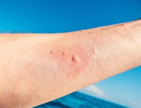 Come curare la puntura delle meduse