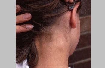 Medical news today menyebutkan bahwa lipoma faktor lain yang menyebabkan benjolan di belakang telinga. Benjolan Di Leher Sebelah Kanan Bawah Telinga & Cara ...