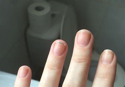 Terry's nails are a type of apparent leukonychia, characterized by ground glass opacification of nearly the entire nail, obliteration of the lunula, and a narrow band of normal, pink nail bed at the distal border. Leukonychia Vs Terry S Nails - Nail Ftempo