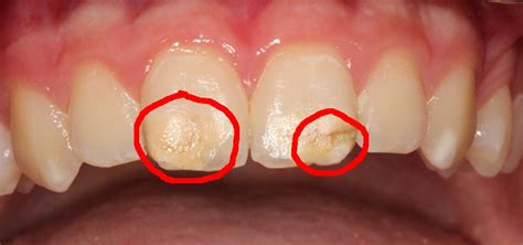 Die ersten zähne, die durchbrechen, sind backenzähne, genauer: Wo Sind Die Backenzähne