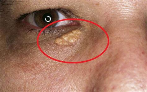 Pictures of gel up with kinky for round face How to Treat Xanthelasma or Cholesterol Deposits Around ...