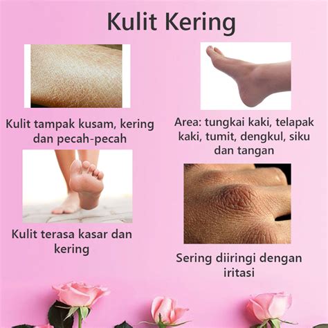 Maybe you would like to learn more about one of these? Cara Mengatasi Kulit Kering Pada Telapak Tangan