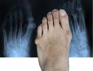 A tailor's bunion is also known as a bunionette. Tailor's Bunions Treatment - My FootDr