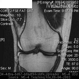 Two collateral ligaments on each side, two cruciate. How To Read A Knee Mri Acl Tear