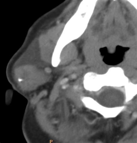 A case is presented of a young female with parotid recurrent pleomorphic adenoma and skin gli autori descrivono il caso di una giovane donna affetta da adenoma pleomorfo parotideo ricorrente ed. ARGUS - Diagnóstico médico