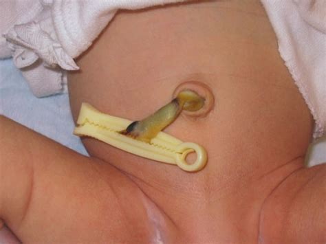 Skip the rubbing alcohol and other ointments, and follow these umbilical cord tips to. Umbilical Cord | Newborn Nursery | Stanford Medicine
