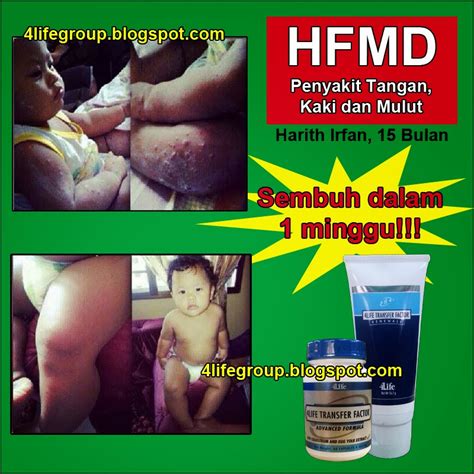 Bagaimana penyakit tangan, kaki dan mulut. Testimoni 4Life Transfer Factor - 4Life Transfer Factor ...