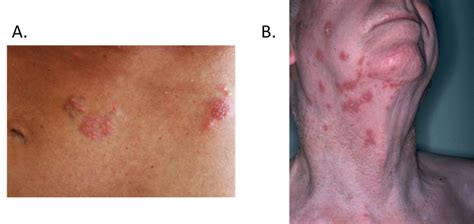 The view from the top. 15.3.1.1.1.2: Varicella Zoster Virus (HHV3) - Biology ...