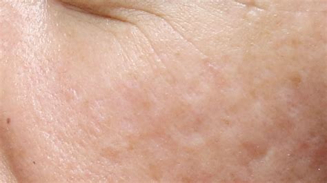 Le laser contre les cicatrices d'acné ou chirurgicales. Traitement de cicatrice d'acné | Médecine esthétique à ...
