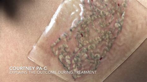 Rainone, md individual results may … Laser Tattoo Removal with PFD Patch and Results! - YouTube