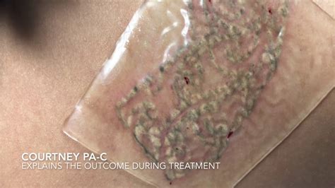 Rainone, md individual results may … Laser Tattoo Removal with PFD Patch and Results! - YouTube