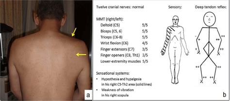 This muscular system chart shows in detail the deep layers of muscle on the back side of your body. a) A picture of the patient's back. Muscle atrophy of the ...