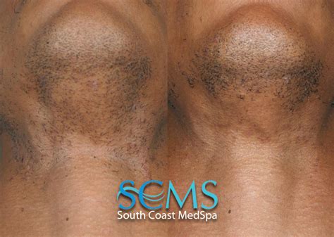 I have these little goosebump like bumps in many places. Laser Hair Removal For Men | Los Angeles | Orange County ...