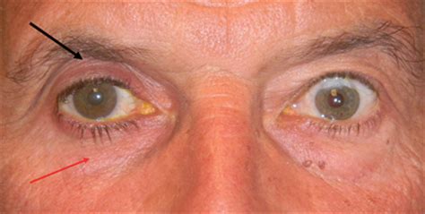 Cases of darkening eye pigment from latisse are rare, but. Bimatoprost Eye Color Change