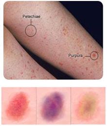Purpura is common with typhus and can be prese. Púrpura Trombocitopénica Inmunitaria - Fedhemo