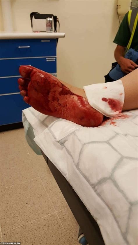 Both tendons and ligaments are dense regular connective tissue, because of its two properties: Mum Suffers Horrific Injuries After Wine Bottle Severs Her ...